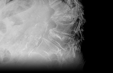 Lumbar Fracture X-ray